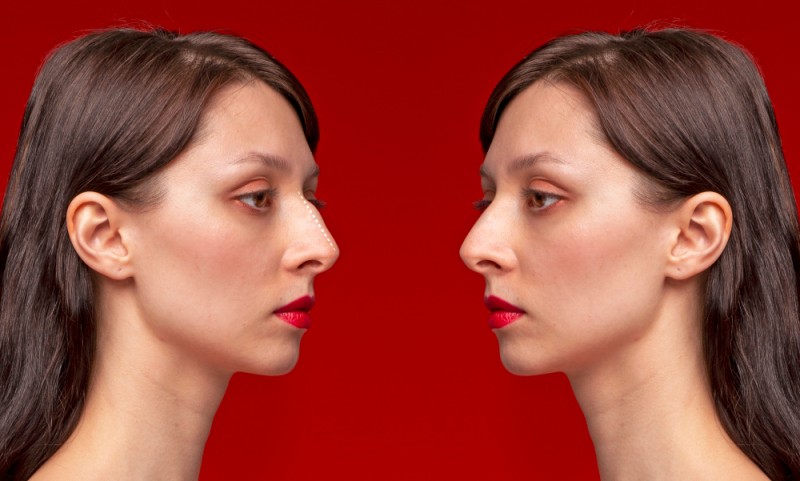Nose Surgery / Rhinoplasty